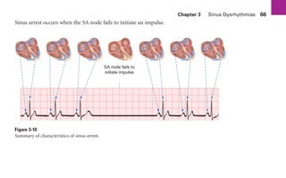 Chapter 3 Sinus Dysrhythmias 66
Sinus arrest occurs when the SA node fails to initiate an impulse.
Figure 3-10
Summary of characteristics of sinus arrest.
SA node fails to
initiate impulse
sha19766_cp03.indd 66
sha19766_cp03.indd 66 7/24/06 11:37:17 AM
7/24/06 11:37:17 AM
 