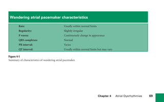 Chapter 4 Atrial Dysrhythmias 69
Wandering atrial pacemaker characteristics
Rate: Usually within normal limits
Regularity: Slightly irregular
P waves: Continuously change in appearance
QRS complexes: Normal
PR interval: Varies
QT interval: Usually within normal limits but may vary
Figure 4-1
Summary of characteristics of wandering atrial pacemaker.
sha19766_cp04.indd 69
sha19766_cp04.indd 69 7/24/06 11:52:57 AM
7/24/06 11:52:57 AM
 