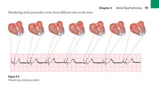 Chapter 4 Atrial Dysrhythmias 70
Wandering atrial pacemaker arises from different sites in the atria.
Figure 4-2
Wandering atrial pacemaker.
sha19766_cp04.indd 70
sha19766_cp04.indd 70 7/24/06 11:52:57 AM
7/24/06 11:52:57 AM
 