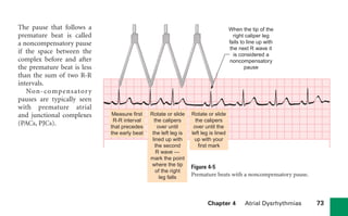 Chapter 4 Atrial Dysrhythmias 73
The pause that follows a
premature beat is called
a noncompensatory pause
if the space between the
complex before and after
the premature beat is less
than the sum of two R-R
intervals.
Non-compensatory
pauses are typically seen
with premature atrial
and junctional complexes
(PACs, PJCs).
When the tip of the
right caliper leg
fails to line up with
the next R wave it
is considered a
noncompensatory
pause
Measure first
R-R interval
that precedes
the early beat
Rotate or slide
the calipers
over until
the left leg is
lined up with
the second
R wave —
mark the point
where the tip
of the right
leg falls
Rotate or slide
the calipers
over until the
left leg is lined
up with your
first mark
Figure 4-5
Premature beats with a noncompensatory pause.
sha19766_cp04.indd 73
sha19766_cp04.indd 73 7/24/06 11:52:57 AM
7/24/06 11:52:57 AM
 