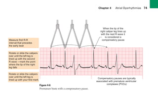 Chapter 4 Atrial Dysrhythmias 74
When the tip of the
right caliper leg lines up
with the next R wave it
is considered a
compensatory pause
Measure first R-R
interval that precedes
the early beat
Compensatory pauses are typically
associated with premature ventricular
complexes (PVCs)
Rotate or slide the calipers
over until the left leg is
lined up with the second
R wave —mark the point
where the tip of the right
leg falls
Rotate or slide the calipers
over until the left leg is
lined up with your first mark
Figure 4-6
Premature beats with a compensatory pause.
sha19766_cp04.indd 74
sha19766_cp04.indd 74 7/24/06 11:52:58 AM
7/24/06 11:52:58 AM
 