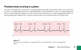 Chapter 4 Atrial Dysrhythmias 75
Premature beats occurring in a pattern
One way to describe PACs is how they are intermingled among the normal beats. When every other beat
is a PAC, it is called bigeminal PACs, or atrial bigeminy. If every third beat is a PAC, it is called trigeminal
PACs, or atrial trigeminy. Likewise, if a PAC occurs every fourth beat, it is called quadrigeminal PACs, or
atrial quadrigeminy. Regular PACs at greater intervals than every fourth beat have no special name.
Figure 4-7
Premature atrial complexes: (a) bigeminal PACs, (b) trigeminal PACs, and (c) quadrigeminal
PACs.
Normal
a)
Normal Normal Normal PAC
PAC
PAC
PAC
sha19766_cp04.indd 75
sha19766_cp04.indd 75 7/24/06 11:52:58 AM
7/24/06 11:52:58 AM
 