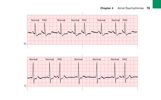 Chapter 4 Atrial Dysrhythmias 76
Normal
Normal
b)
c)
Normal Normal Normal Normal PAC
PAC
PAC
Normal Normal Normal Normal PAC
PAC
sha19766_cp04.indd 76
sha19766_cp04.indd 76 7/24/06 11:52:58 AM
7/24/06 11:52:58 AM
 
