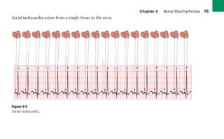 Chapter 4 Atrial Dysrhythmias 78
Atrial tachycardia arises from a single focus in the atria.
Figure 4-9
Atrial tachycardia.
sha19766_cp04.indd 78
sha19766_cp04.indd 78 7/24/06 11:52:58 AM
7/24/06 11:52:58 AM
 