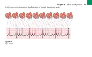 Chapter 4 Atrial Dysrhythmias 82
Atrial flutter arises from rapid depolarization of a single focus in the atria.
Figure 4-13
Atrial flutter.
sha19766_cp04.indd 82
sha19766_cp04.indd 82 7/24/06 11:52:59 AM
7/24/06 11:52:59 AM
 