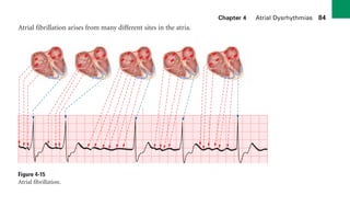 Chapter 4 Atrial Dysrhythmias 84
Atrial fibrillation arises from many different sites in the atria.
Figure 4-15
Atrial fibrillation.
sha19766_cp04.indd 84
sha19766_cp04.indd 84 7/24/06 11:52:59 AM
7/24/06 11:52:59 AM
 