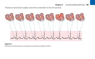 Chapter 5 Junctional Dysrhythmias 88
Premature junctional complex arises from somewhere in the AV junction.
Figure 5-2
Summary of characteristics of premature junctional complexes (PJCs).
sha19766_cp05.indd 88
sha19766_cp05.indd 88 7/24/06 1:51:32 PM
7/24/06 1:51:32 PM
 