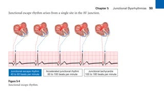 Chapter 5 Junctional Dysrhythmias 90
Junctional escape rhythm arises from a single site in the AV junction.
Figure 5-4
Junctional escape rhythm.
Junctional escape rhythm
40 to 60 beats per minute
Accelerated junctional rhythm
60 to 100 beats per minute
Junctional tachycardia
100 to 180 beats per minute
sha19766_cp05.indd 90
sha19766_cp05.indd 90 7/24/06 1:51:32 PM
7/24/06 1:51:32 PM
 