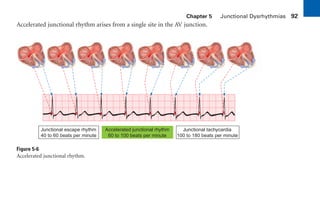Chapter 5 Junctional Dysrhythmias 92
Accelerated junctional rhythm arises from a single site in the AV junction.
Figure 5-6
Accelerated junctional rhythm.
Junctional escape rhythm
40 to 60 beats per minute
Accelerated junctional rhythm
60 to 100 beats per minute
Junctional tachycardia
100 to 180 beats per minute
sha19766_cp05.indd 92
sha19766_cp05.indd 92 7/24/06 1:51:32 PM
7/24/06 1:51:32 PM
 