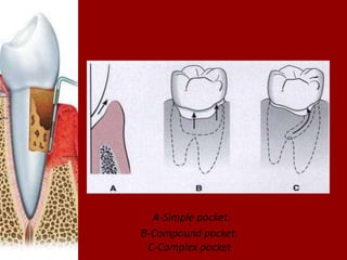 Periodontal Pockets | PPTX
