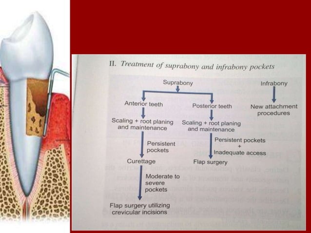 Periodontal Pockets | PPT