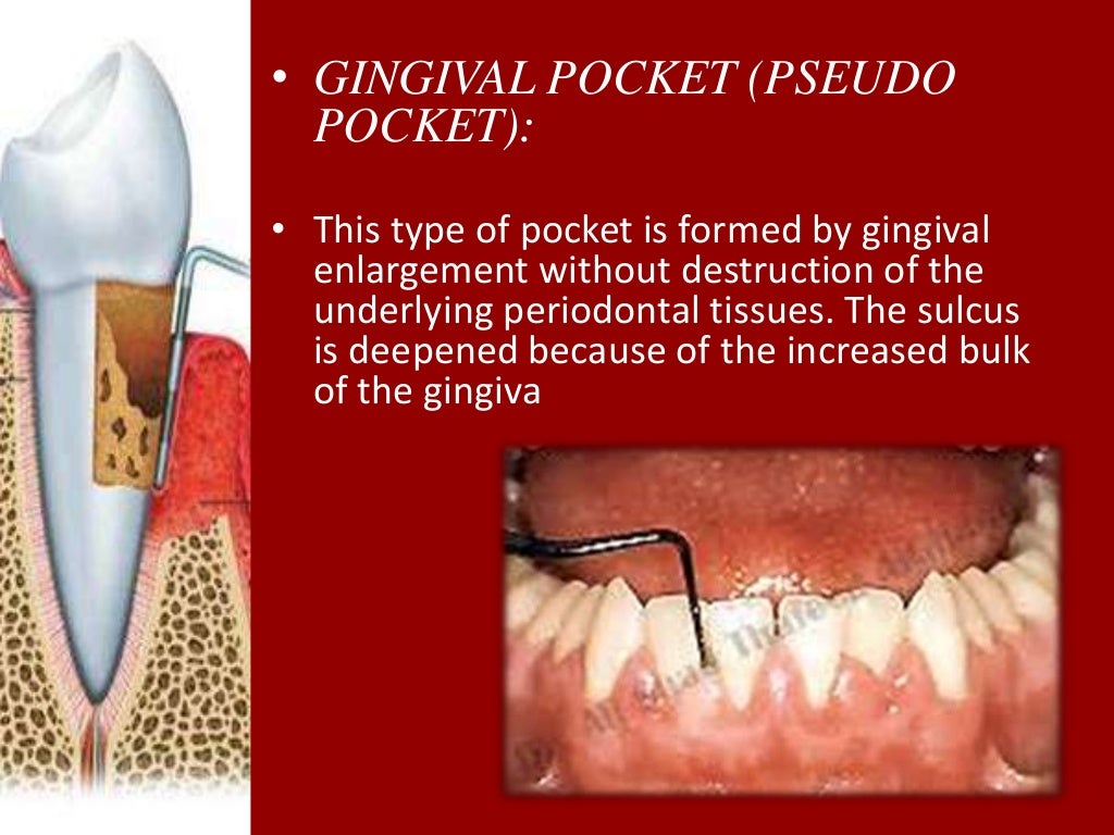 Periodontal Pockets