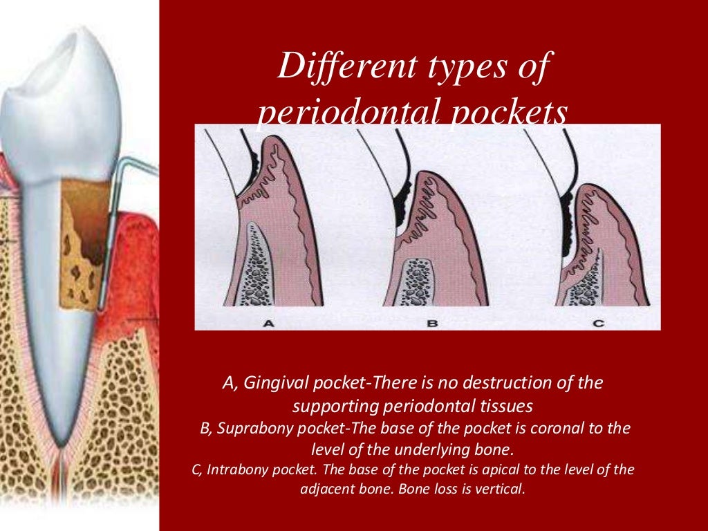 Periodontal Pockets