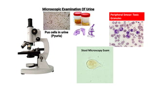 Stool Microscopy Exam
Peripheral Smear: Toxic
Granules
 