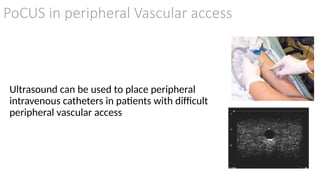 Pocus Foot Injection Point of Care Ultrasound- Basic of USG in POCUS.pptx