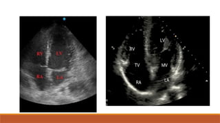 Point of care ultrasound and 2D echocardiography | PPTX
