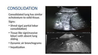 POCUS DYSPNEA Dr.GANESH in trauma lung fields | PPTX
