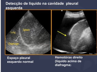 Protocolo FAST POCUS | PDF