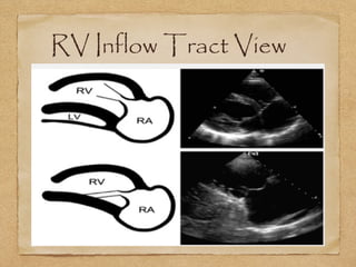 Tg Rv Inflow View Tee Point of Care Cardiac U/S | PPT