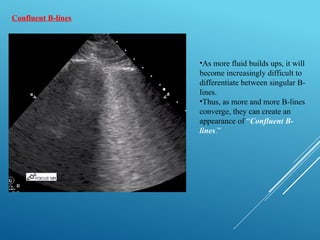 APPROACH TO POCUS IN ACUTE RESPIRATORY FAILURE.pptx