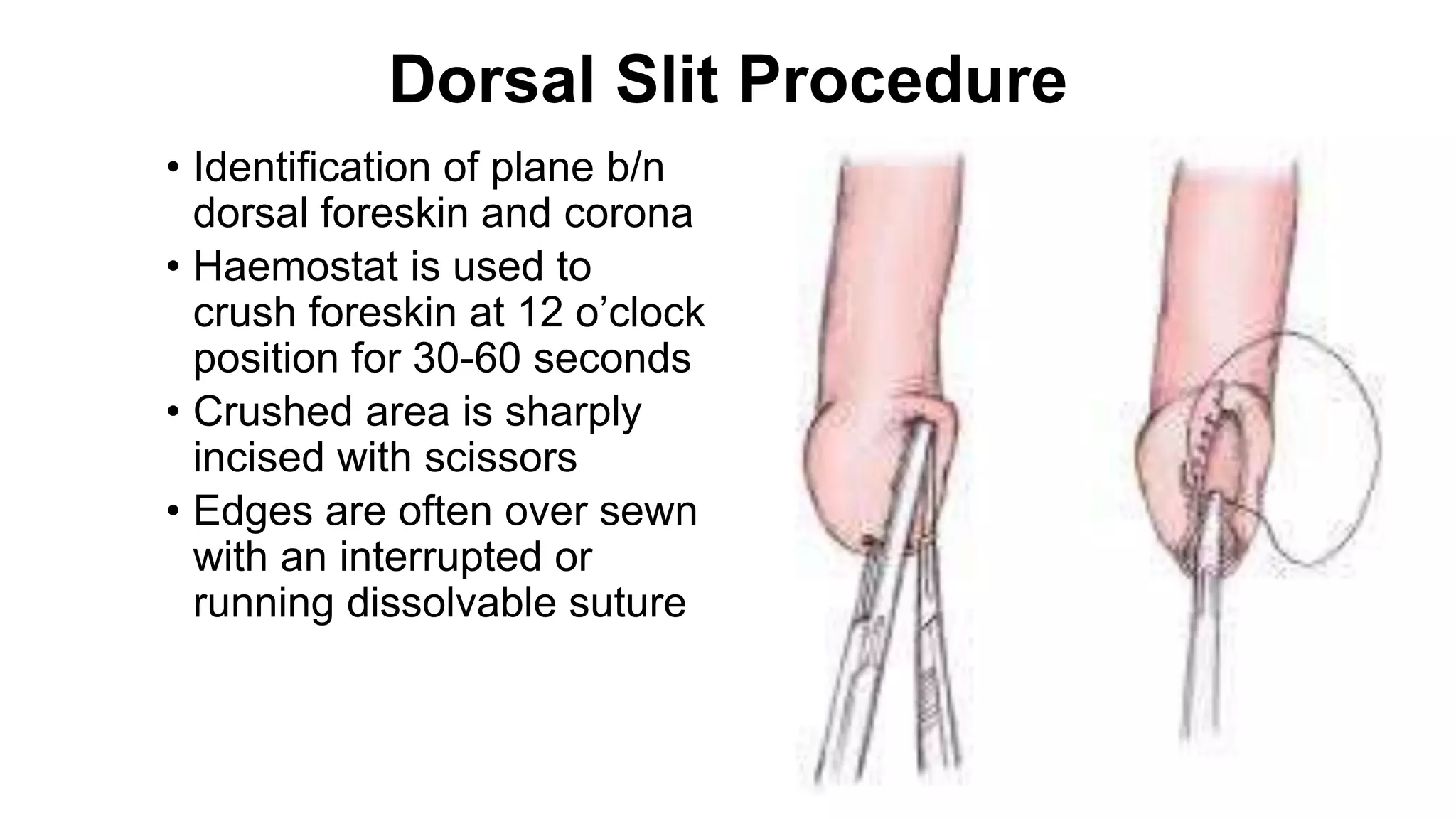 Penile abnormalities | PPTX
