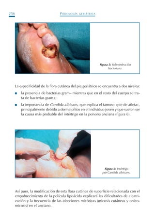 PODOLOGÍA GERIÁTRICA256
La especificidad de la flora cutánea del pie geriátrico se encuentra a dos niveles:
I la presencia de bacterias gram– mientras que en el resto del cuerpo se tra-
ta de bacterias gram+;
I la importancia de Candida albicans, que explica el famoso «pie de atleta»,
principalmente debido a dermatofitos en el individuo joven y que suelen ser
la causa más probable del intértrigo en la persona anciana (figura 6).
Figura 5: Sobreinfección
bacteriana.
Figura 6: Intértrigo
por Candida albicans.
Así pues, la modificación de esta flora cutánea de superficie relacionada con el
empobrecimiento de la película lipoácida explicará las dificultades de cicatri-
zación y la frecuencia de las afecciones micóticas (micosis cutáneas y onico-
micosis) en el anciano.
Podología geriátrica 001-382 3/8/07 10:21 Página 256
 
