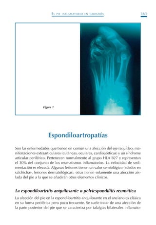 EL PIE INFLAMATORIO EN GERIATRÍA 363
Espondiloartropatías
Son las enfermedades que tienen en común una afección del eje raquídeo, ma-
nifestaciones extraarticulares (cutáneas, oculares, cardioaórticas) y un síndrome
articular periférico. Pertenecen normalmente al grupo HLA B27 y representan
el 30% del conjunto de los reumatismos inflamatorios. La velocidad de sedi-
mentación es elevada. Algunas lesiones tienen un valor semiológico («dedos en
salchicha», lesiones dermatológicas), otras tienen solamente una afección ais-
lada del pie a la que se añadirán otros elementos clínicos.
La espondiloartritis anquilosante o pelviespondilitis reumática
La afección del pie en la espondiloartritis anquilosante en el anciano es clásica
en su forma periférica pero poco frecuente. Se suele tratar de una afección de
la parte posterior del pie que se caracteriza por talalgias bilaterales inflamato-
Figura 1
Podología geriátrica 001-382 3/8/07 10:23 Página 363
 