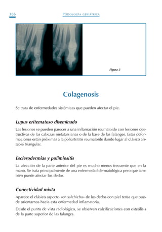 PODOLOGÍA GERIÁTRICA366
Colagenosis
Se trata de enfermedades sistémicas que pueden afectar el pie.
Lupus eritematoso diseminado
Las lesiones se pueden parecer a una inflamación reumatoide con lesiones des-
tructivas de las cabezas metatarsianas o de la base de las falanges. Estas defor-
maciones están próximas a la poliartrititis reumatoide dando lugar al clásico an-
tepié triangular.
Esclerodermias y polimiositis
La afección de la parte anterior del pie es mucho menos frecuente que en la
mano. Se trata principalmente de una enfermedad dermatológica pero que tam-
bién puede afectar los dedos.
Conectividad mixta
Aparece el clásico aspecto «en salchicha» de los dedos con piel tensa que pue-
de orientarnos hacia esta enfermedad inflamatoria.
Desde el punto de vista radiológico, se observan calcificaciones con osteólisis
de la parte superior de las falanges.
Figura 3
Podología geriátrica 001-382 3/8/07 10:23 Página 366
 