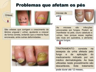 Problemas que afetam os pés
São orteses que corrigem o crescimento da
lâmina ungueal ( unha), ajudando a crescer
de forma correta, evitando que a mesma fique
encravada, entre outras deformidades.
Ortese
bracket
Fibra molecular
micose de
unha
As micoses são infecções
provocadas por fungos. Podem se
manifestar na pele, couro cabeludo e
unhas. Isso porque essas regiões
são ricas em queratina, o alimento
desses fungos.
TRATRAMENTO: consiste na
assepsia da unha afetada pelo
fungo e da aplicação do
medicamento indicado por um
médico dermatologista. As lixas
utilizadas neste procedimento são
descartáveis. Este tratamento
pode durar até 12 meses.
 