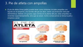 3. Pie de atleta con ampollas
 El pie de atleta (tinea pedis) puede tener como síntomas iniciales ampollas con
líquido en el empeine y los bordes del pie (es decir, tener una evolución vesicular
dishidrótica). Debido a la gruesa capa córnea en la planta del pie, estas ampollas no
revientan espontáneamente, sino que se secan. Como consecuencia se tensa la piel y
empieza a picar.
 