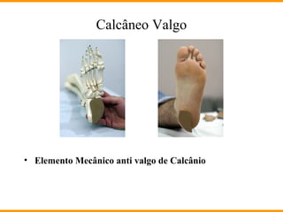 Calcâneo Valgo
• Elemento Mecânico anti valgo de Calcânio
 