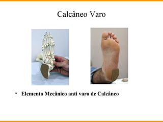 Calcâneo Varo
• Elemento Mecânico anti varo de Calcâneo
 