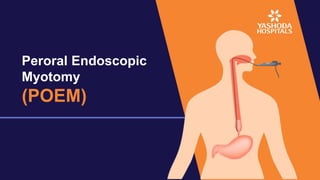 Peroral Endoscopic
Myotomy
(POEM)
 