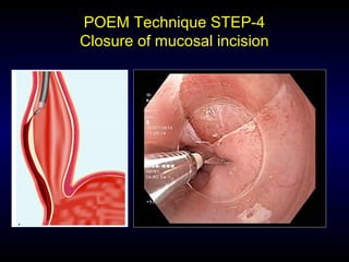 POEM Technique STEP-4
Closure of mucosal incision
 