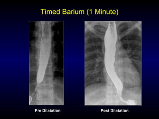 Timed Barium (1 Minute)
Pre Dilatation Post Dilatation
 