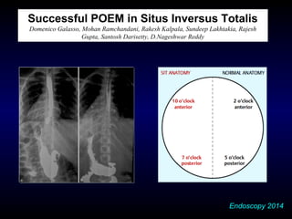 Successful POEM in Situs Inversus Totalis
Domenico Galasso, Mohan Ramchandani, Rakesh Kalpala, Sundeep Lakhtakia, Rajesh
Gupta, Santosh Darisetty, D.Nageshwar Reddy
Endoscopy 2014
 