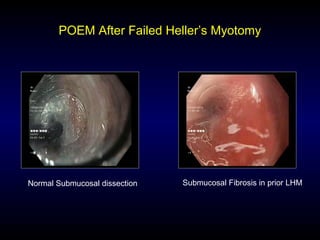 POEM After Failed Heller’s Myotomy
Normal Submucosal dissection Submucosal Fibrosis in prior LHM
 