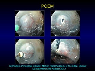 POEM
Technique of mucosal incision: Mohan Ramchandani, D N Reddy. Clinical
Gastroenterol and hepatol 2013
 
