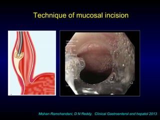 Technique of mucosal incision
Mohan Ramchandani, D N Reddy. Clinical Gastroenterol and hepatol 2013
 