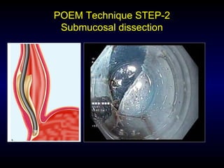 POEM Technique STEP-2
Submucosal dissection
 