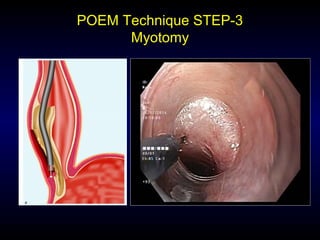 POEM Technique STEP-3
Myotomy
 