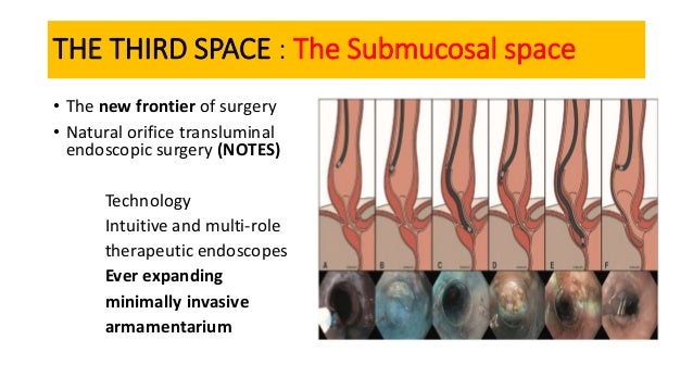 ACHALASIA CARDIA: ENDOSCOPIC THERAPY (POEM)