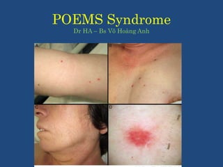 POEMS Syndrome
Dr HA – Bs Võ Hoàng Anh
 