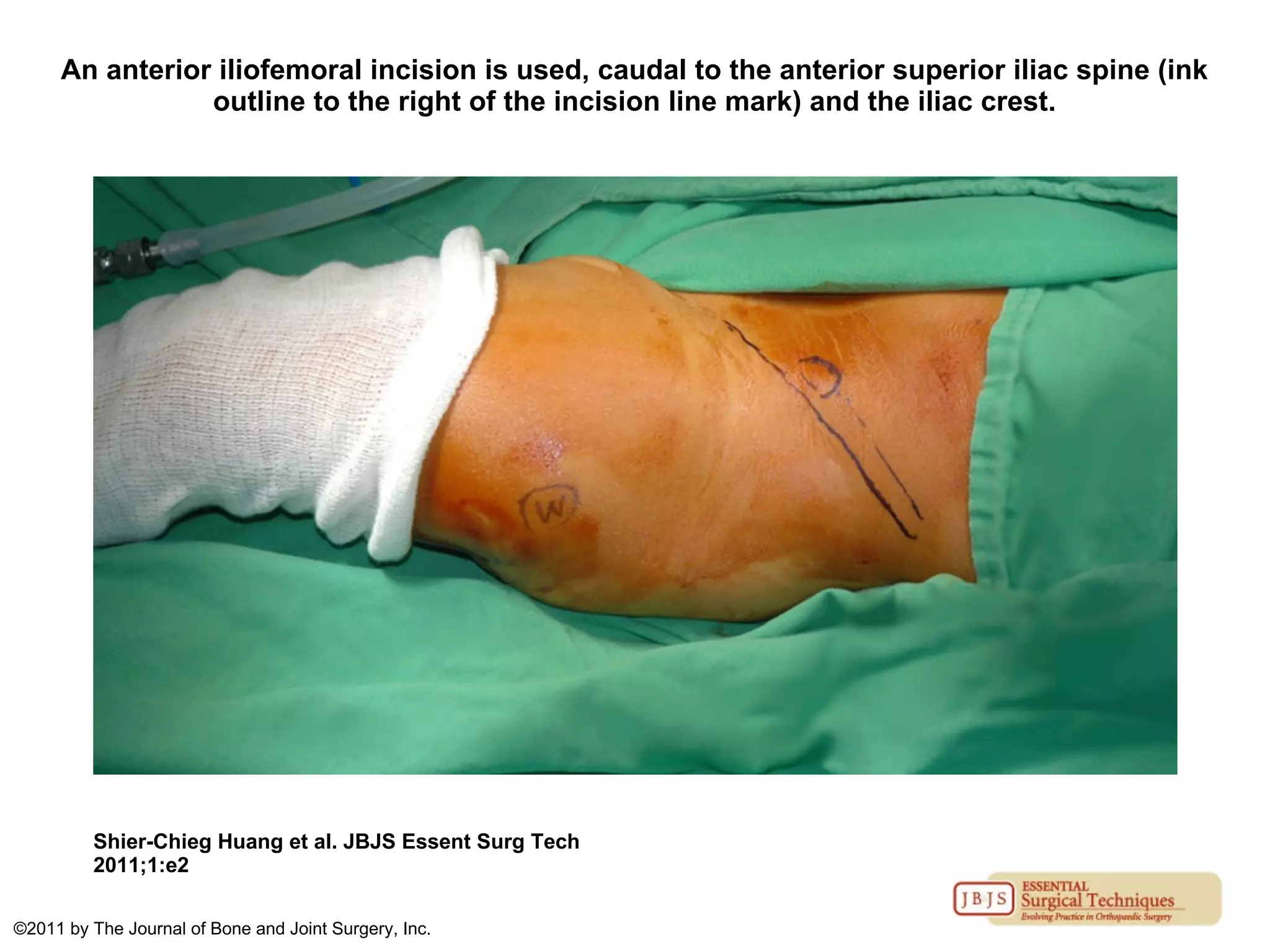 An anterior iliofemoral incision is used, caudal to the anterior superior iliac spine (ink
outline to the right of the incision line mark) and the iliac crest.
Shier-Chieg Huang et al. JBJS Essent Surg Tech
2011;1:e2
©2011 by The Journal of Bone and Joint Surgery, Inc.
 