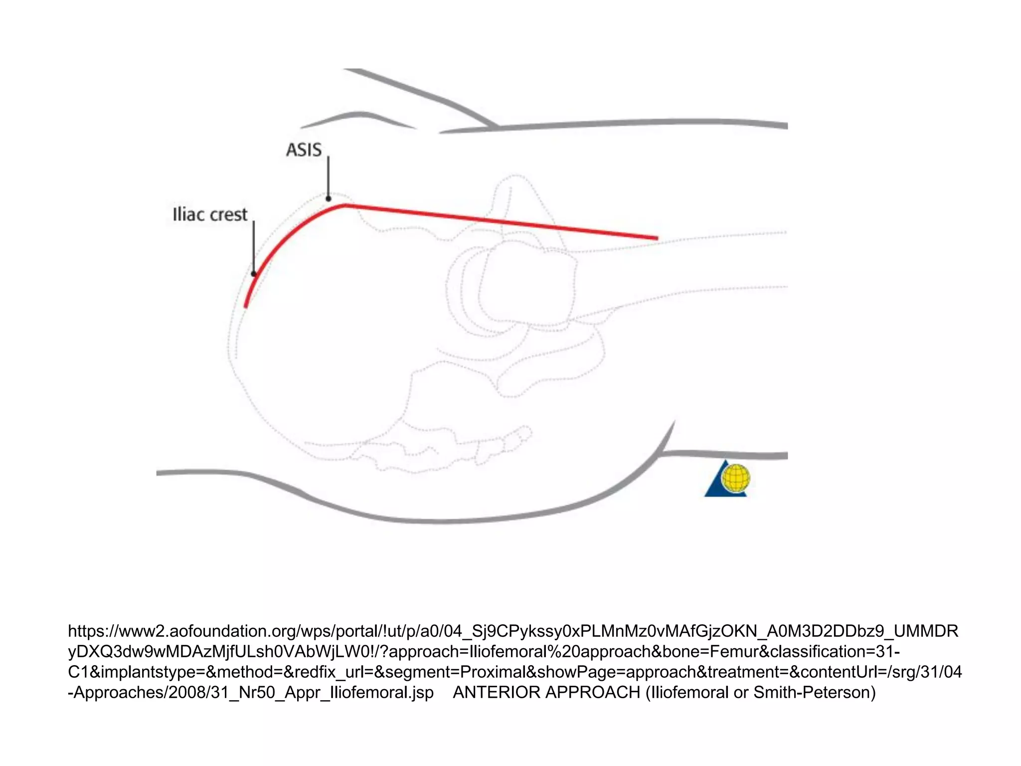 https://www2.aofoundation.org/wps/portal/!ut/p/a0/04_Sj9CPykssy0xPLMnMz0vMAfGjzOKN_A0M3D2DDbz9_UMMDR
yDXQ3dw9wMDAzMjfULsh0VAbWjLW0!/?approach=Iliofemoral%20approach&bone=Femur&classification=31-
C1&implantstype=&method=&redfix_url=&segment=Proximal&showPage=approach&treatment=&contentUrl=/srg/31/04
-Approaches/2008/31_Nr50_Appr_Iliofemoral.jsp ANTERIOR APPROACH (Iliofemoral or Smith-Peterson)
 