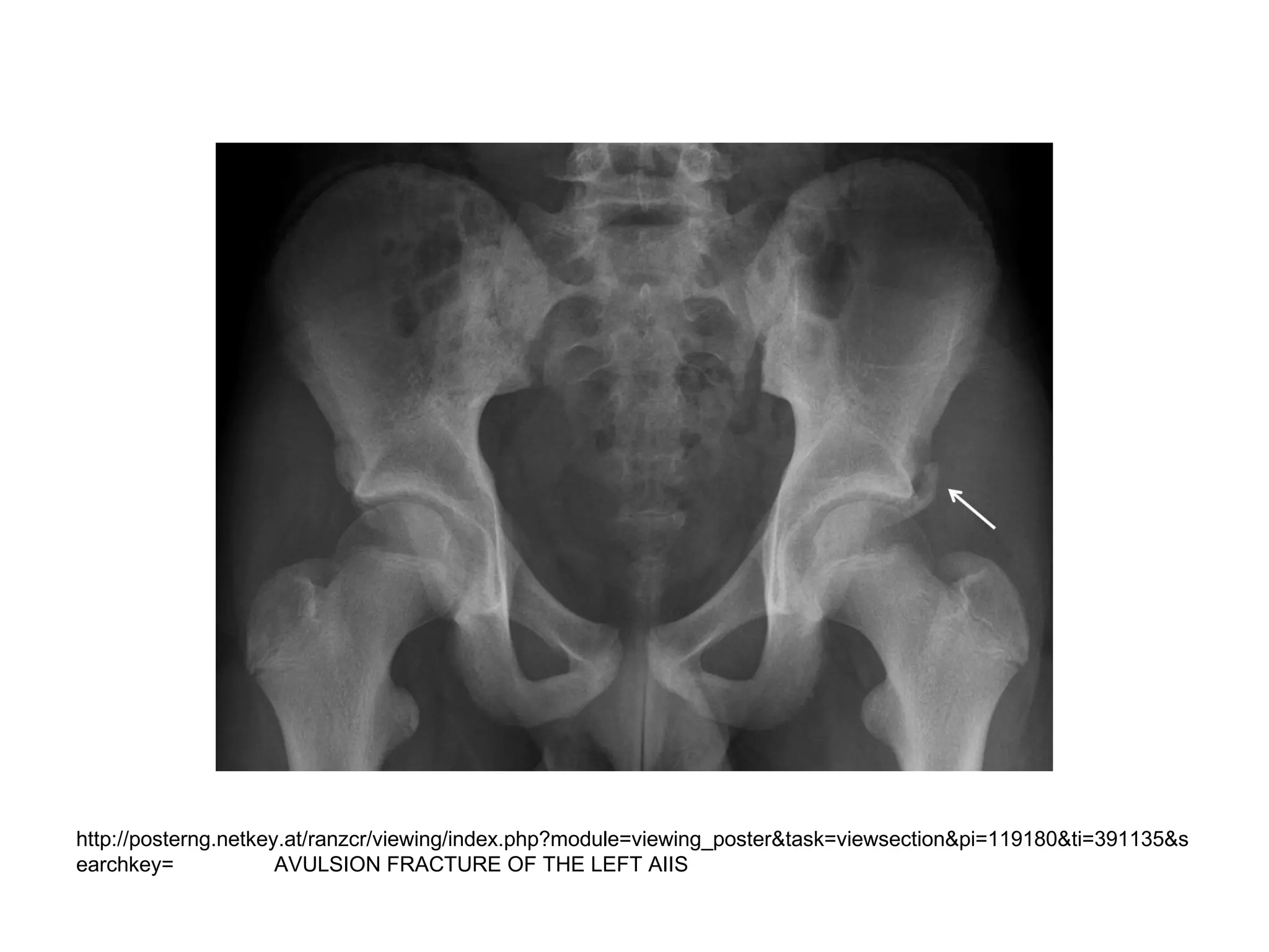 http://posterng.netkey.at/ranzcr/viewing/index.php?module=viewing_poster&task=viewsection&pi=119180&ti=391135&s
earchkey= AVULSION FRACTURE OF THE LEFT AIIS
 
