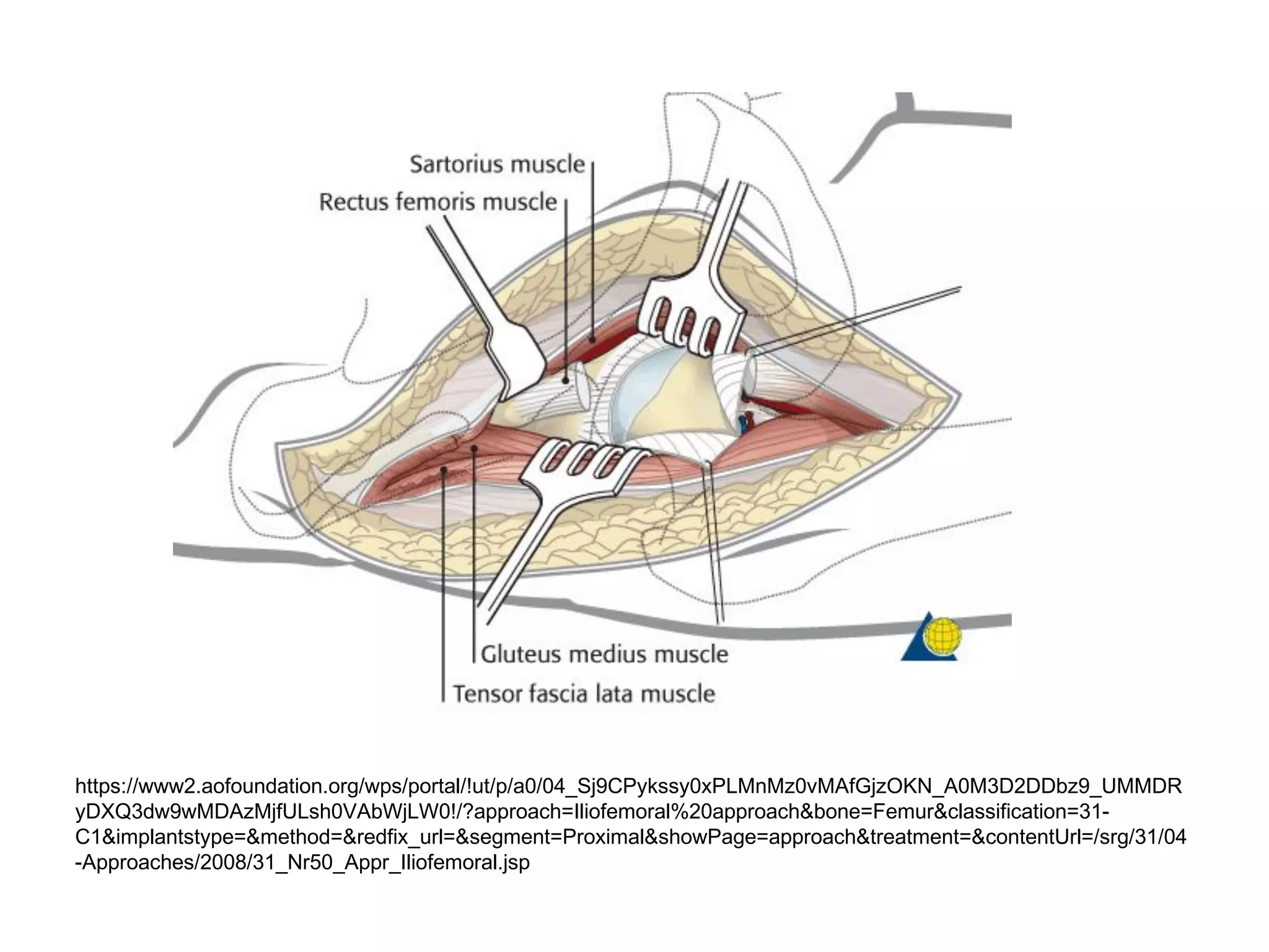 https://www2.aofoundation.org/wps/portal/!ut/p/a0/04_Sj9CPykssy0xPLMnMz0vMAfGjzOKN_A0M3D2DDbz9_UMMDR
yDXQ3dw9wMDAzMjfULsh0VAbWjLW0!/?approach=Iliofemoral%20approach&bone=Femur&classification=31-
C1&implantstype=&method=&redfix_url=&segment=Proximal&showPage=approach&treatment=&contentUrl=/srg/31/04
-Approaches/2008/31_Nr50_Appr_Iliofemoral.jsp
 
