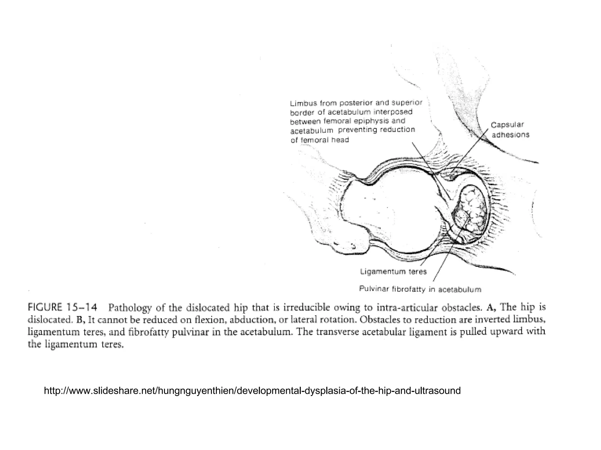http://www.slideshare.net/hungnguyenthien/developmental-dysplasia-of-the-hip-and-ultrasound
 