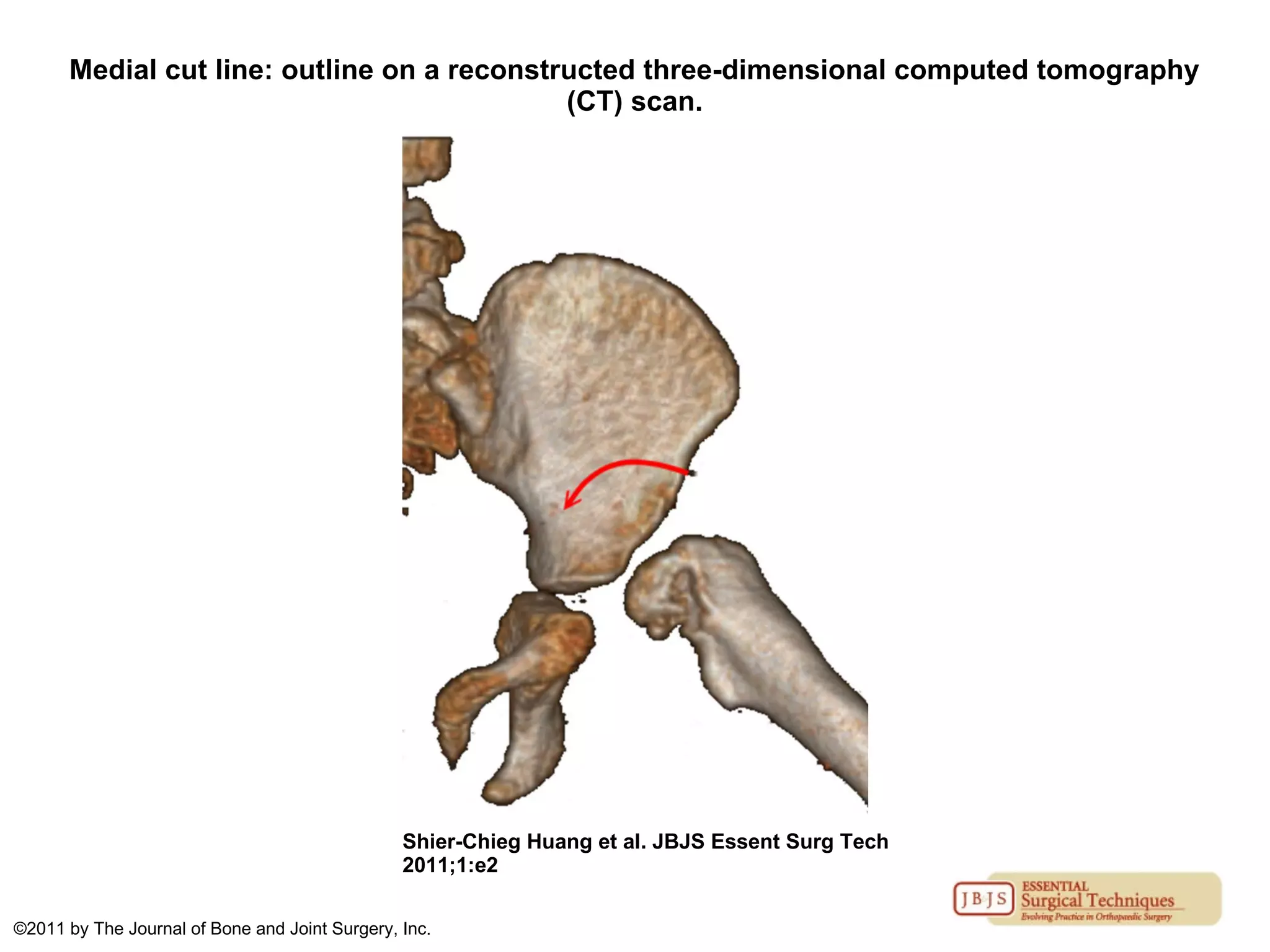 Medial cut line: outline on a reconstructed three-dimensional computed tomography
(CT) scan.
Shier-Chieg Huang et al. JBJS Essent Surg Tech
2011;1:e2
©2011 by The Journal of Bone and Joint Surgery, Inc.
 