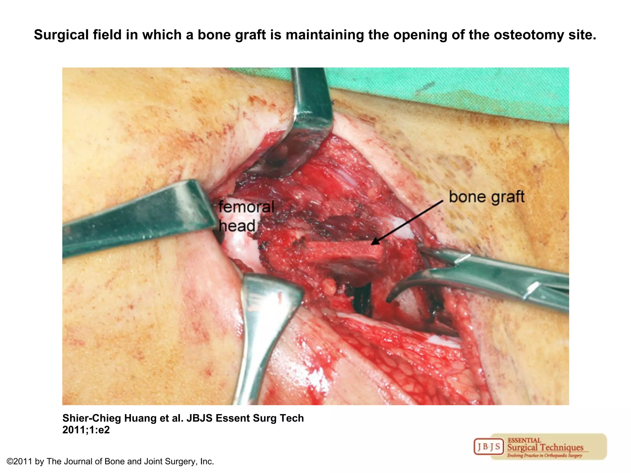 Surgical field in which a bone graft is maintaining the opening of the osteotomy site.
Shier-Chieg Huang et al. JBJS Essent Surg Tech
2011;1:e2
©2011 by The Journal of Bone and Joint Surgery, Inc.
 